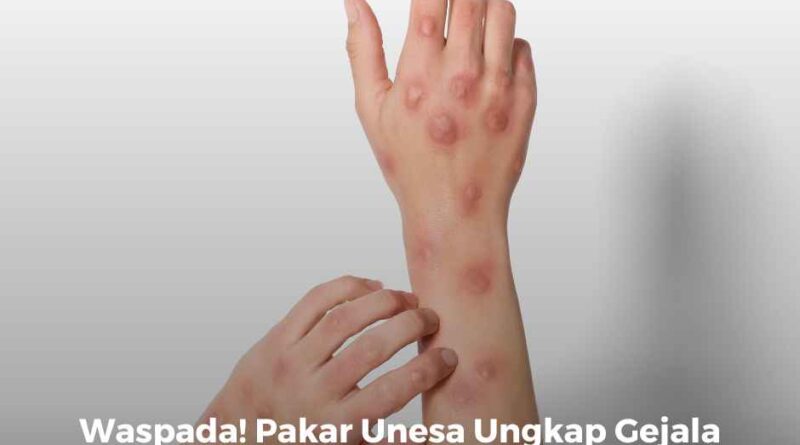 Waspada! Pakar Unesa Ungkap Gejala dan Tips Pencegahan Cacar Monyet